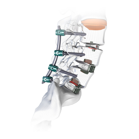 CAMBER ORTHROS MIS Surgical Technique Guide