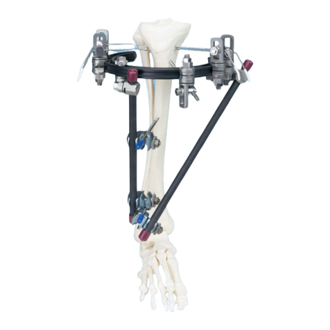 Synthes Hybrid Fixator Proximal Tibia Frame Technique guide