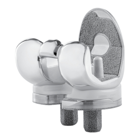Zimmer Persona Trabecular Metal Femoral Component SURGICAL TECHNIQUE